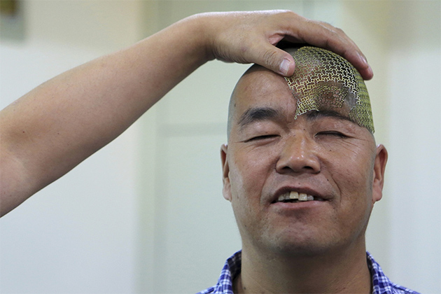 ایمپلنت جمجمه چاپ سه‌بعدی در حال ساخت