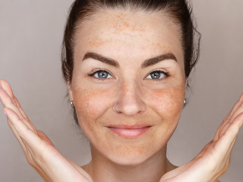 درمان لک های پوستی با PDRN