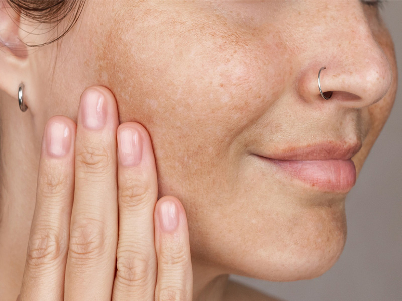 درمان لک های پوستی با PDRN