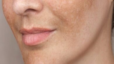 درمان لک های پوستی با PDRN